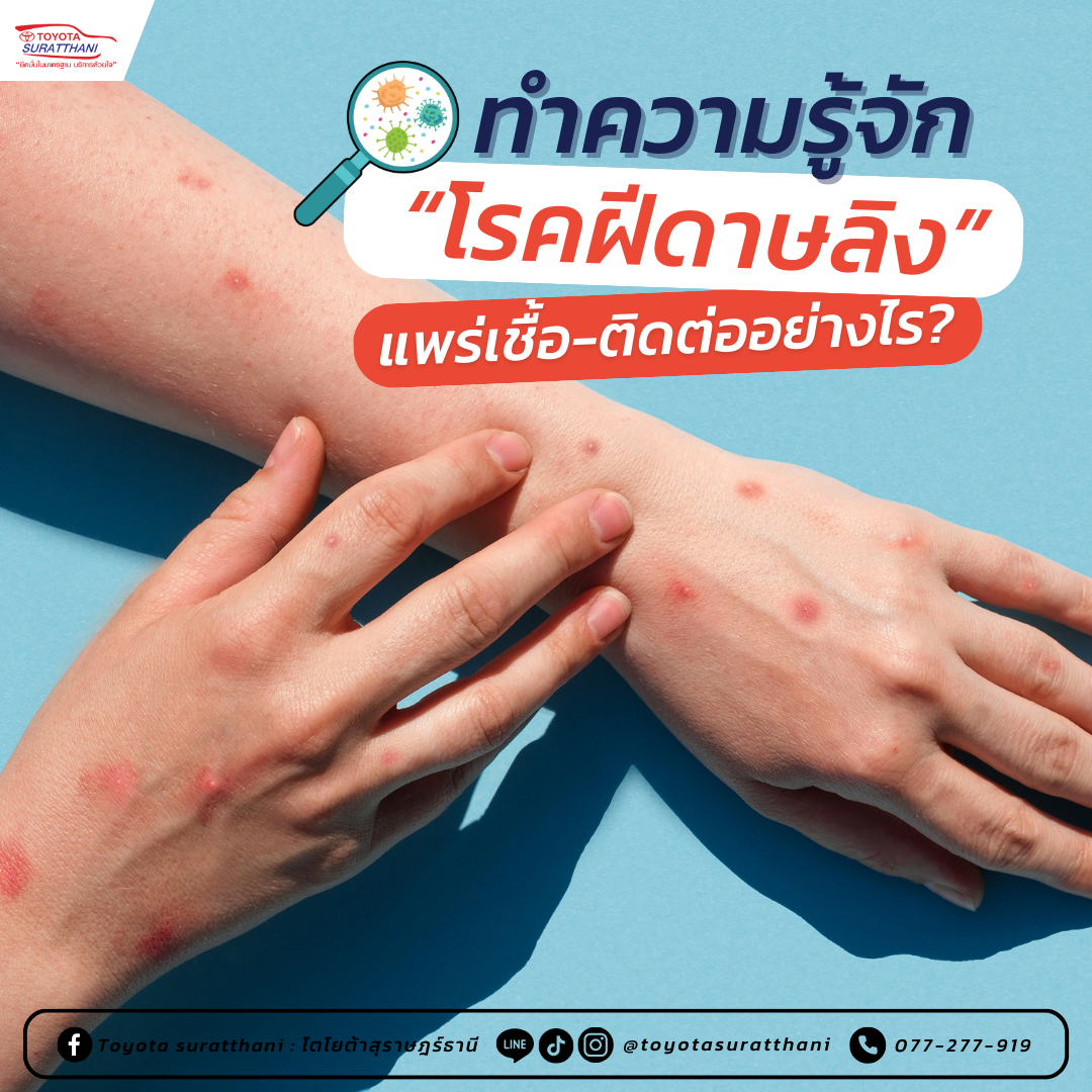 ทำความรู้จัก “โรคฝีดาษลิง” (Monkeypox) แพร่เชื้อ-ติดต่ออย่างไร?